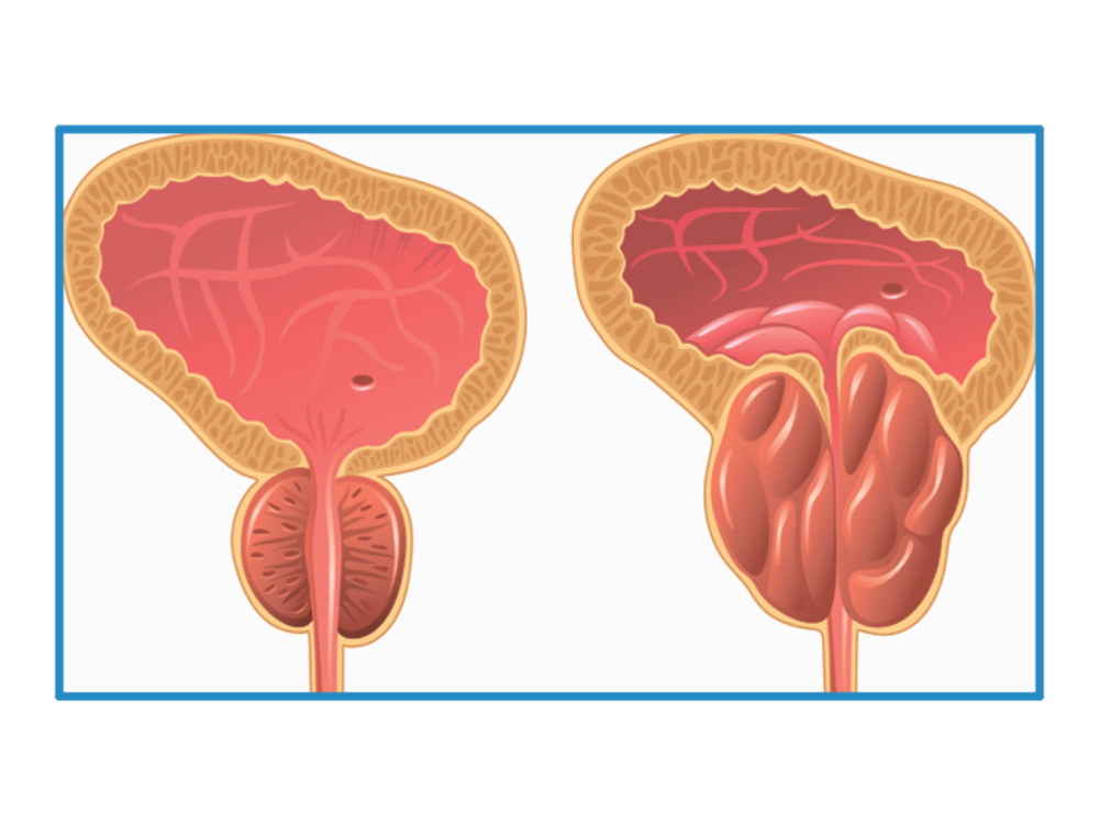 скринінг раку простати