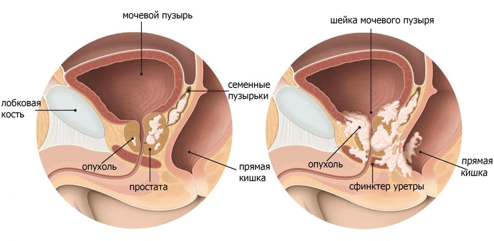скринінг раку простати