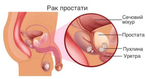 Чому скринінг раку простати включає аналіз на ПСА?