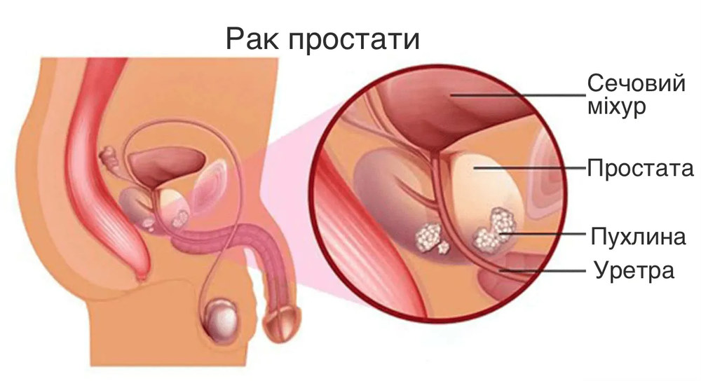 Чому скринінг раку простати включає аналіз на ПСА?